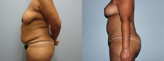 Mommy Makeover result at Westfield Plastic Surgery Center in Omaha, NE
