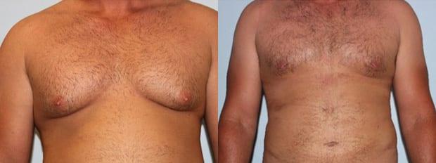 Liposuction result at Westfield Plastic Surgery Center in Omaha, NE