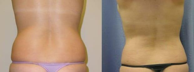Liposuction result at Westfield Plastic Surgery Center in Omaha, NE