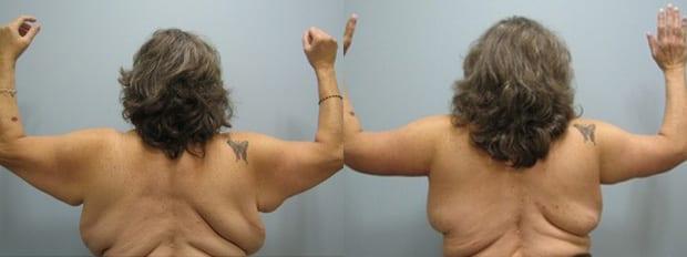Arm Lift result at Westfield Plastic Surgery Center in Omaha, NE