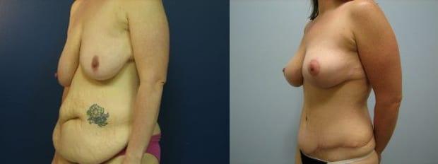 Mommy Makeover result at Westfield Plastic Surgery Center in Omaha, NE