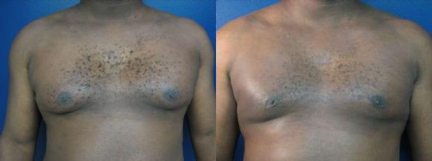 Westfield Plastic Surgery Center gynecomastia result — Omaha, NE