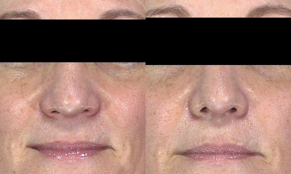 Westfield Plastic Surgery Center rhinoplasty result — Omaha, NE