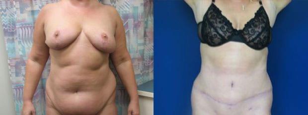 Tummy Tuck result at Westfield Plastic Surgery Center in Omaha, NE