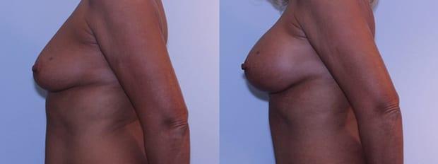 Breast Augmentation result at Westfield Plastic Surgery Center in Omaha, NE