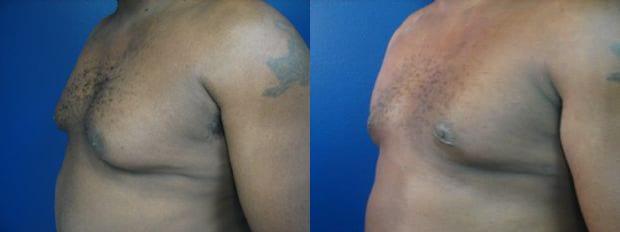 Westfield Plastic Surgery Center gynecomastia result — Omaha, NE