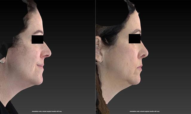 Rhinoplasty result at Westfield Plastic Surgery Center in Omaha, NE
