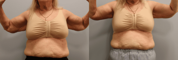 Arm Lift result at Westfield Plastic Surgery Center in Omaha, NE