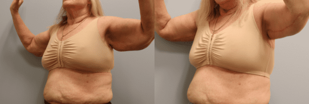 Arm Lift result at Westfield Plastic Surgery Center in Omaha, NE
