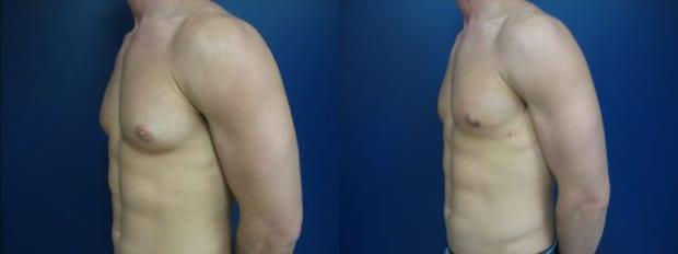 Gynecomastia Surgery result at Westfield Plastic Surgery Center in Omaha, NE