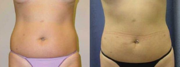 Liposuction result at Westfield Plastic Surgery Center in Omaha, NE