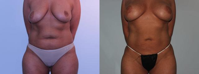 Liposuction result at Westfield Plastic Surgery Center in Omaha, NE