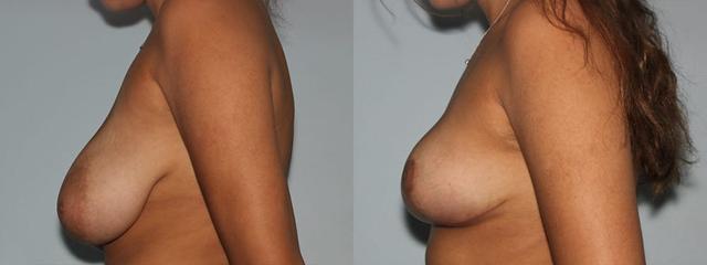 Breast Lift result at Westfield Plastic Surgery Center in Omaha, NE
