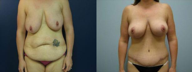 Mommy Makeover result at Westfield Plastic Surgery Center in Omaha, NE