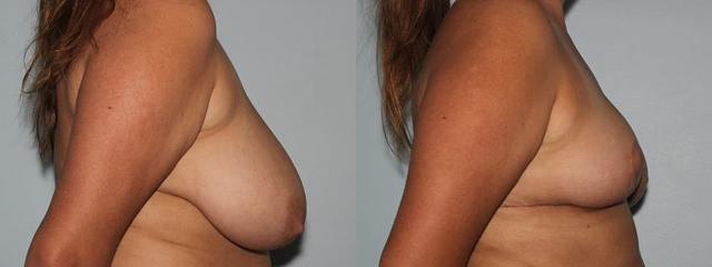 Breast Reduction result at Westfield Plastic Surgery Center in Omaha, NE
