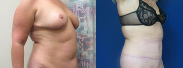 Tummy Tuck result at Westfield Plastic Surgery Center in Omaha, NE