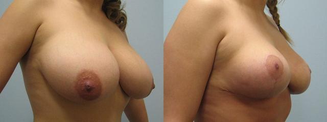Breast Reduction result at Westfield Plastic Surgery Center in Omaha, NE
