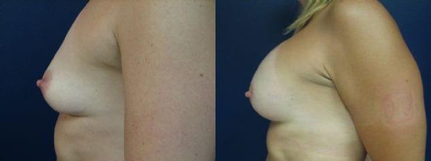 Breast Augmentation result at Westfield Plastic Surgery Center in Omaha, NE