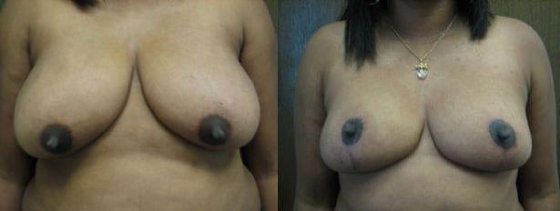 Breast Reduction result at Westfield Plastic Surgery Center in Omaha, NE