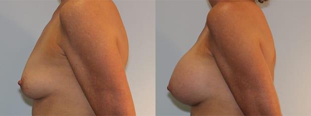 Breast Augmentation result at Westfield Plastic Surgery Center in Omaha, NE