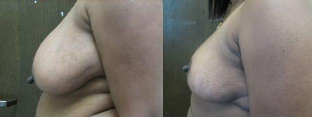 Breast Reduction result at Westfield Plastic Surgery Center in Omaha, NE