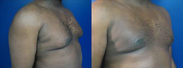 Gynecomastia Surgery result at Westfield Plastic Surgery Center in Omaha, NE