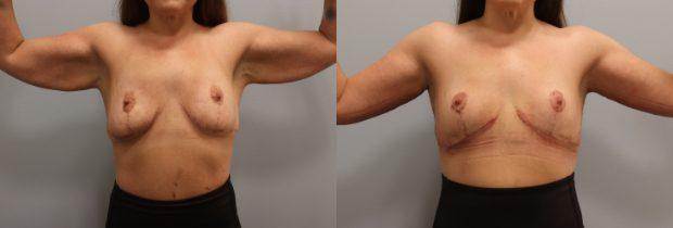 Arm Lift result at Westfield Plastic Surgery Center in Omaha, NE