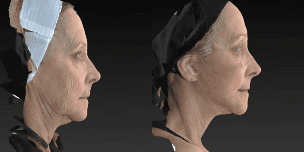 Facelift result at Westfield Plastic Surgery Center in Omaha, NE