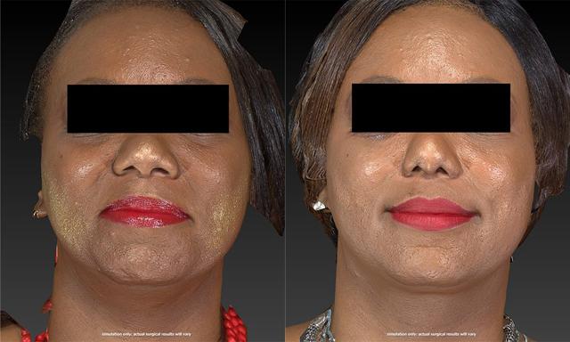 Rhinoplasty result at Westfield Plastic Surgery Center in Omaha, NE