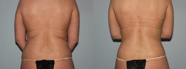 Liposuction result at Westfield Plastic Surgery Center in Omaha, NE