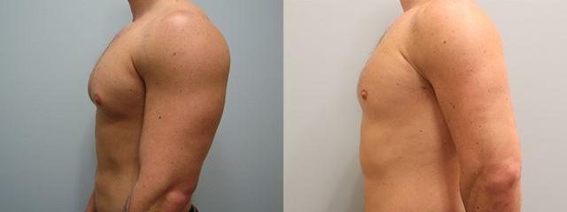 Gynecomastia Surgery result at Westfield Plastic Surgery Center in Omaha, NE