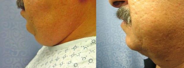 Liposuction result at Westfield Plastic Surgery Center in Omaha, NE
