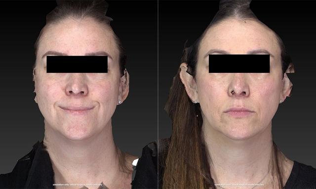 Rhinoplasty result at Westfield Plastic Surgery Center in Omaha, NE