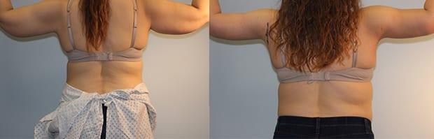 Arm Lift result at Westfield Plastic Surgery Center in Omaha, NE