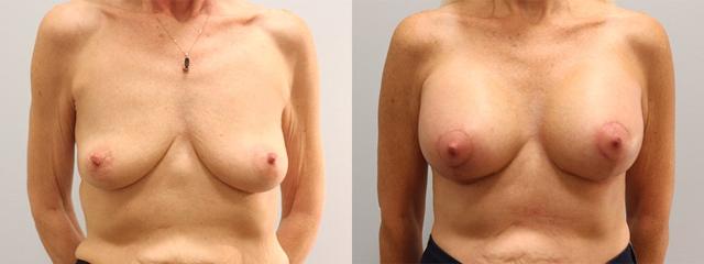 Breast Lift result at Westfield Plastic Surgery Center in Omaha, NE