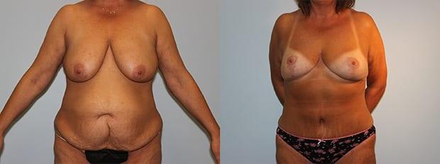 Mommy Makeover result at Westfield Plastic Surgery Center in Omaha, NE