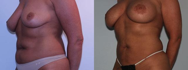 Liposuction result at Westfield Plastic Surgery Center in Omaha, NE