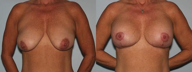 Breast Lift result at Westfield Plastic Surgery Center in Omaha, NE