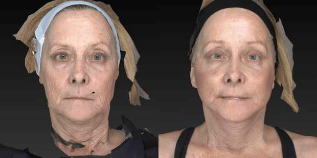 Facelift result at Westfield Plastic Surgery Center in Omaha, NE