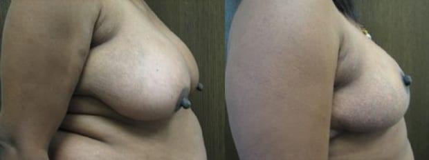 Breast Reduction result at Westfield Plastic Surgery Center in Omaha, NE