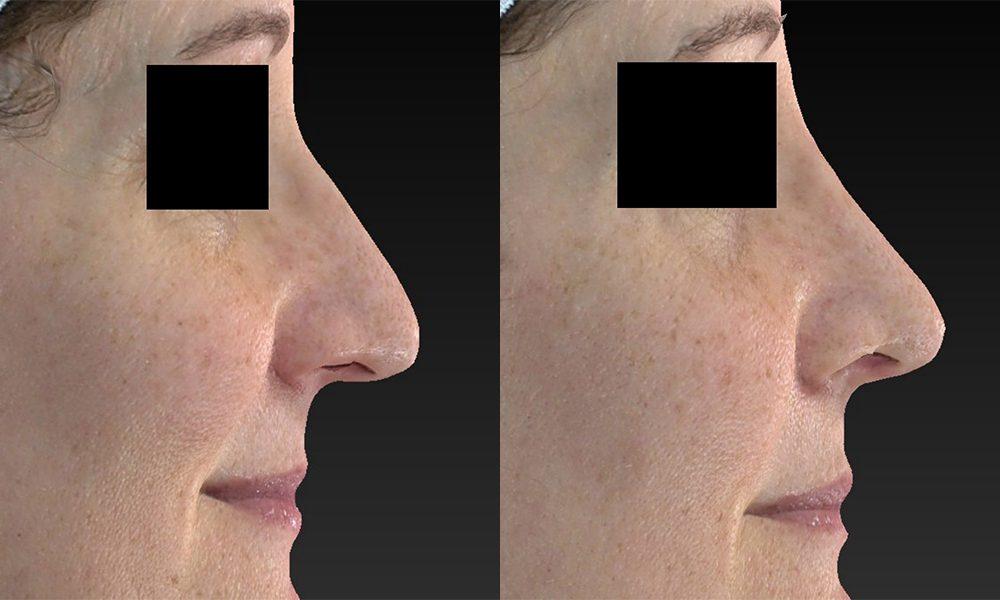 Westfield Plastic Surgery Center rhinoplasty result — Omaha, NE