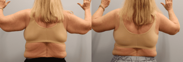 Arm Lift result at Westfield Plastic Surgery Center in Omaha, NE