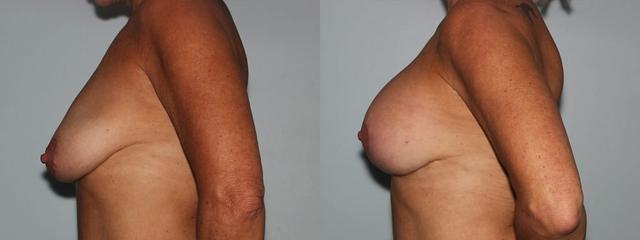 Breast Lift result at Westfield Plastic Surgery Center in Omaha, NE