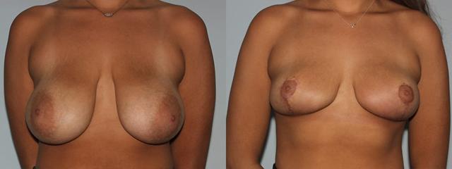 Breast Lift result at Westfield Plastic Surgery Center in Omaha, NE