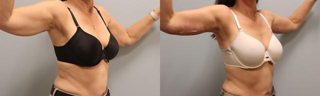 Arm Lift result at Westfield Plastic Surgery Center in Omaha, NE