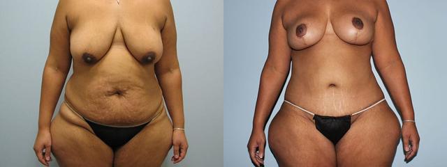 Mommy Makeover result at Westfield Plastic Surgery Center in Omaha, NE