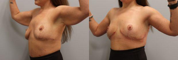 Arm Lift result at Westfield Plastic Surgery Center in Omaha, NE