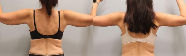 Arm Lift result at Westfield Plastic Surgery Center in Omaha, NE