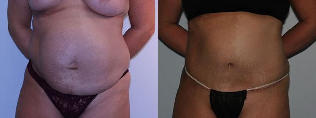 Tummy Tuck result at Westfield Plastic Surgery Center in Omaha, NE