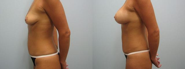 Mommy Makeover result at Westfield Plastic Surgery Center in Omaha, NE